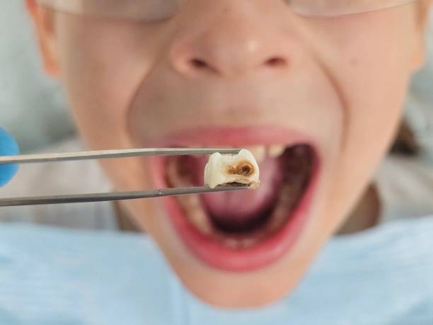 Best Emergency Dental Care for Broken or Chipped Teeth in Puget Island, WA